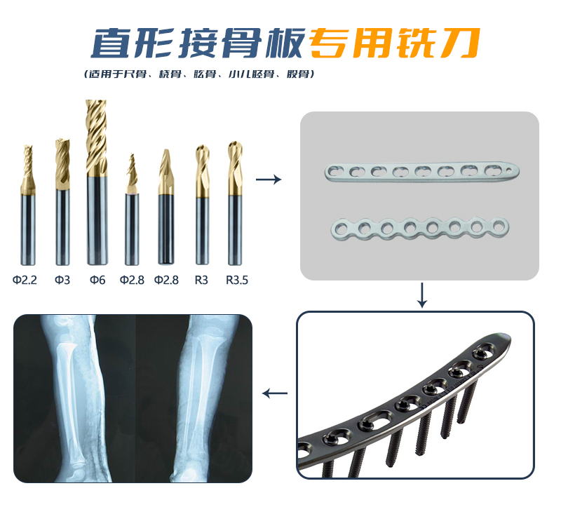 直形接骨板应用(9)